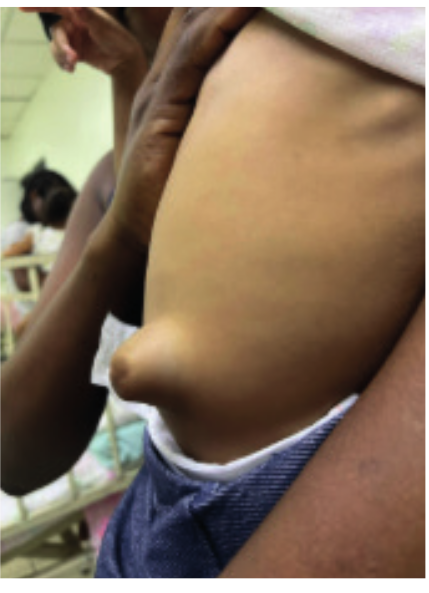 Figura 3. Protuberancia en la región umbilical compatible con una hernia umbilical